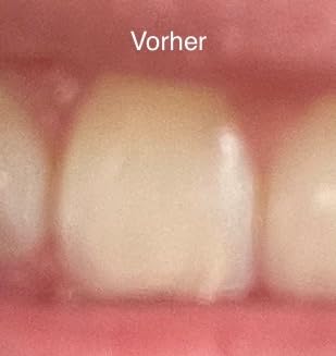 Glatter Zahn